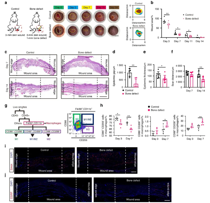 骨缺损可诱导糖尿病足创面更有效的愈合